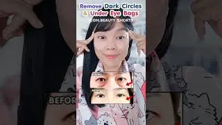 How to Remove Dark Circles and Under-Eye Bags