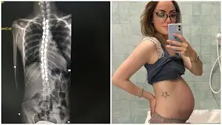 GRAVIDANZA E INTERVENTO ALLA SCOLIOSI - LA MIA ESPERIENZA