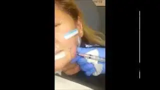 BOTOX in the face
