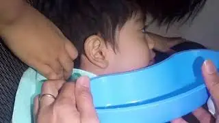 4 Year Old Boy's Ear Irrigation of Massive Earwax