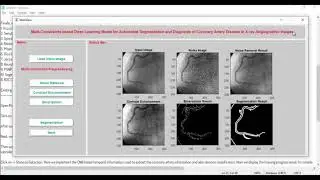 Segmentation of X Ray Coronary Angiographic Images