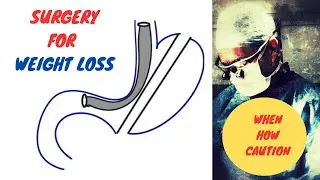 Surgery for Weight Loss