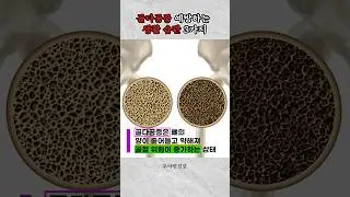 지금부터 관리하자! 골다공증 예방하는 생활습관 3가지 #골다공증 #골다공증예방 #건강정보
