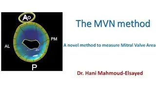 A novel method to measure Mitral Valve Area "The MVN method".