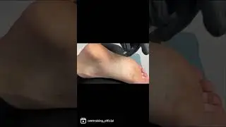 Acupuncture techniques for the foot