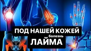 Лайм. Под нашей кожей