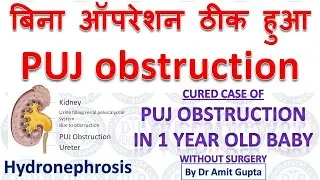 PUJ obstruction (CURED CASE without surgery) |Hydronephrosis due to PUJ obstruction cured|