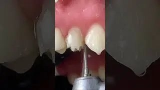O passo a passo completo no meu canal.  #preparodental #estudantedeodonto #dicasdeodonto #dentista