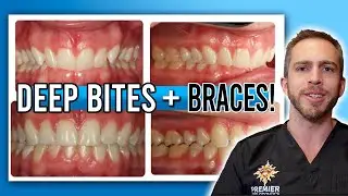 Deep Bite Braces Treatment! [BEFORE & AFTER]