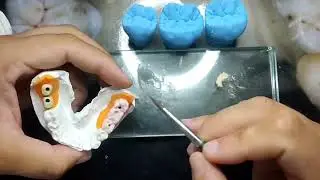 APLICAÇÃO DE UMA PRÓTESE FIXA COM NORITAKE EX3