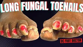 Long Fungal Toenails: Trimming, shaping, cutting