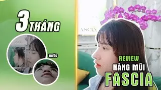 Review ca nâng mũi cấu trúc Fascia sau 3 tháng