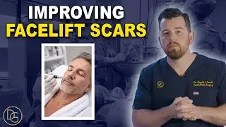 MicroNeedling: One of The Most Effective Anti-Aging Non-Surgical Techniques
