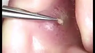 Самое залипательное видео давить прыщи Черные точки