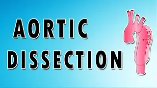 Aortic Dissection
