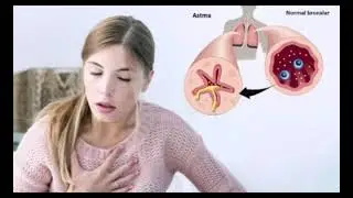 #Astma kasalligini (#bronxial,#astma) kelib chiqish sabablari va uning davosi haqida