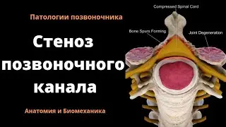 Стеноз позвоночного канала. 3D анатомия.