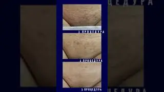Лучше результаты, лазерная эпиляция, новое оборудование
