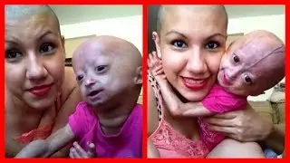 Ela tem apenas 11 anos, mas está envelhecendo muito rápido....conheça a história de Adélia!