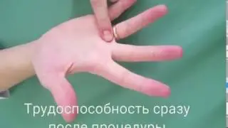 Стенозирующий лигаментит/Щелкающий палец - Лечение без разрезов - Отзыв Пациентки