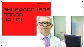 Энцефалоцеле плода на УЗИ в 1 триместре