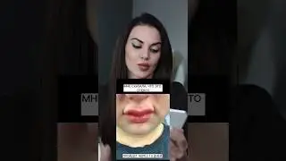 Ожидания\Реальность или последствия неправильного увеличения губ #косметологиямосква