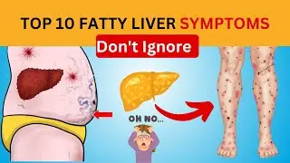 Top 10 signs and symptoms of fatty liver you must avoid