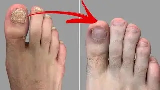 🔥Toenail Fungus Removal: Natural Toenail Fungus Treatment