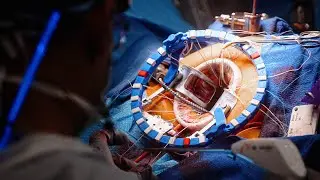 Minimally Invasive Mitral Valve Repair by Tom C. Nguyen, MD, FACS, FACC | Preview