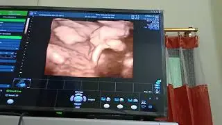 Usg 4d usia kandungan 34-35 minggu