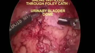 Urachal Remnant Laparoscopic delayed resection