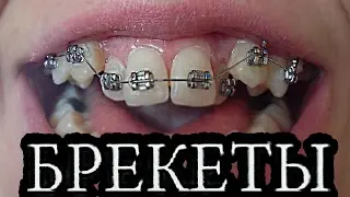 БРЕКЕТЫ/МОЯ УЖАСНАЯ ИСТОРИЯ