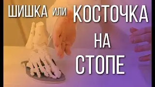 Косточка на стопе – что делать?