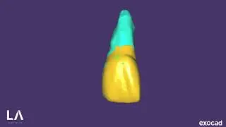 Provisional for Immediate Implant Placement in EXOCAD