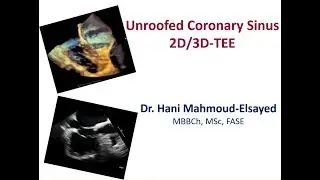 Unroofed Coronary Sinus ...  2D/3D TEE (CS defect)