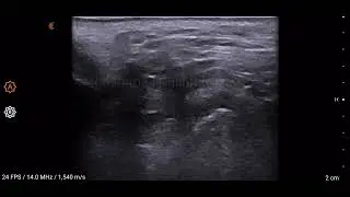 TMJ Ultrasound, Disc Displacement with Reduction