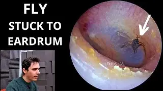 Dead Fly Stuck To Eardrum