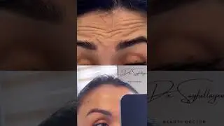Ажинлар билан ишлаш #tashkent #skincare #интересно #botox #uzbekistan #turkey #istanbul #botox
