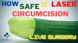 Laser circumcision | Phimosis | Balanitis #definitecure