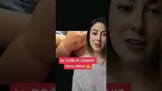 Bir doğum lekeniz varsa dikkat! 