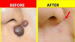 DIY! Natural Remedy to Remove Moles, Warts, Pimples, Acne, Age Spots | 100% EFFECTIVE