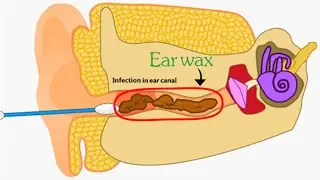 Ear Wax Removal - 2D Animation