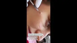 УДАЛЕНИ Е РОДИНОК ПРОИСХОДИТ БЕСКОНТАКТНЫМ СПОСОБОМ С ПОМОЩЬЮ РАДИОВОЛН 🔥