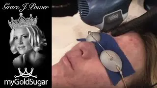 Photo Facial with Suction Tip Facial Demonstration by Grace J Power