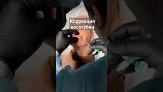 Убираем носогубку.