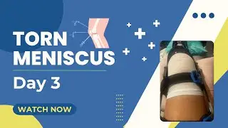 Recovering ❤️‍🩹 from Torn Meniscus Repair