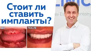 Как создать зуб взамен утраченного? / Всё, что нужно знать об имплантации