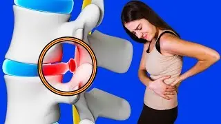Spinal hernia. How I treat intervertebral hernia.