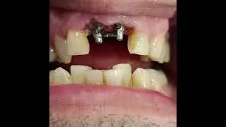 CORONAS FRACTURADAS, QUISTES PERIAPICALES E IMPLANTES BASALES