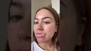 Krystal's Q-Switch Laser Journey